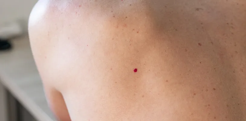 ไฝแดง cherry angioma มีจุดแดงขึ้นตามตัว คล้ายยุงกัด ไม่คัน ไม่เป็นอันตราย