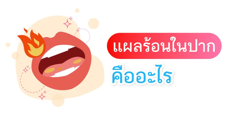 แผลร้อนในปากคืออะไร