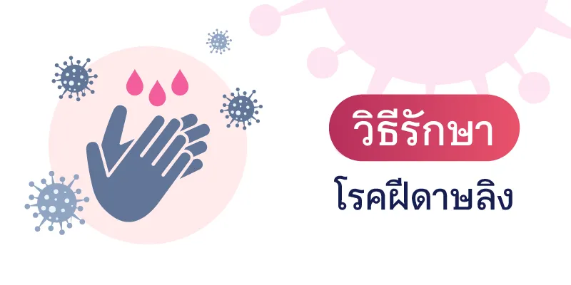 Treatment for Monkeypox
