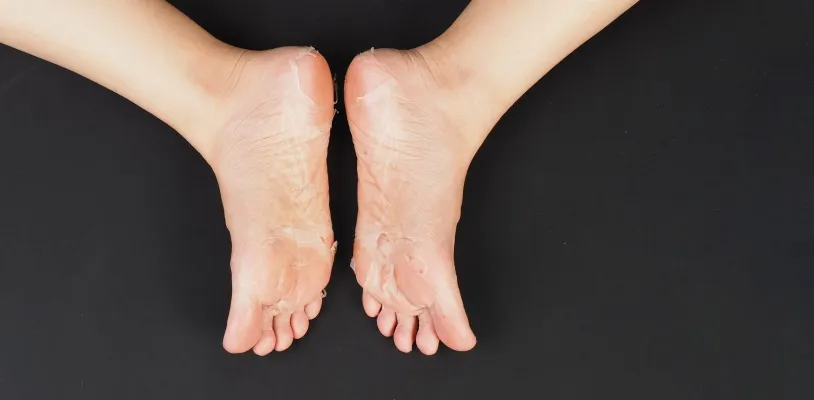 10 สาเหตุหลักที่ทำให้เท้าลอก เกิดจากอะไรได้บ้าง