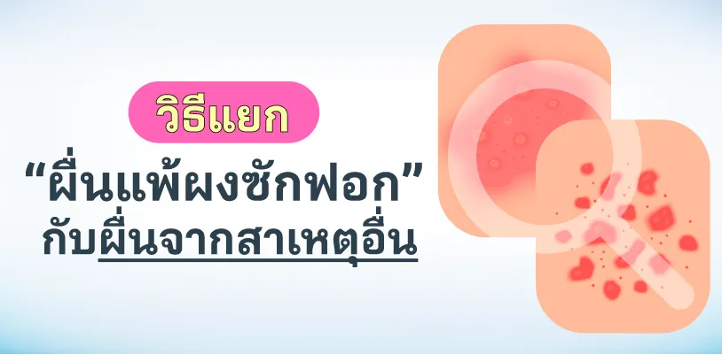 วิธีแยก ผื่นแพ้ผงซักฟอ กับ ผื่นจากสาเหตุอื่น