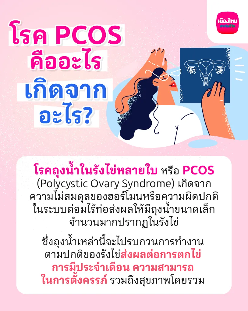 โรค PCOS คืออะไร เกิดจากอะไร?