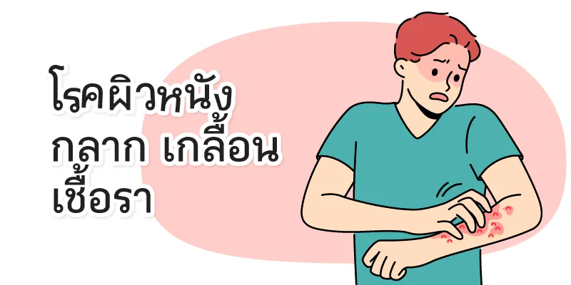 Skin Diseases, Ringworm, Tinea Versicolor, Fungal Infection