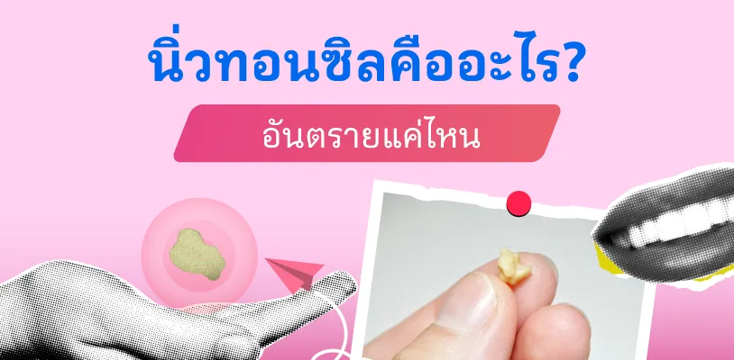 นิ่วทอนซิลคืออะไร? อันตรายแค่ไหน