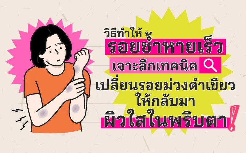 วิธีทำให้รอยช้ำหายเร็ว เจาะลึกเทคนิคเปลี่ยนรอยม่วงดำเขียว ให้กลับมาผิวใสในพริบตา