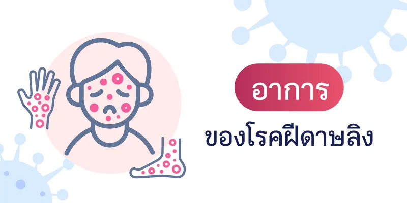 อาการของโรคฝีดาษลิง